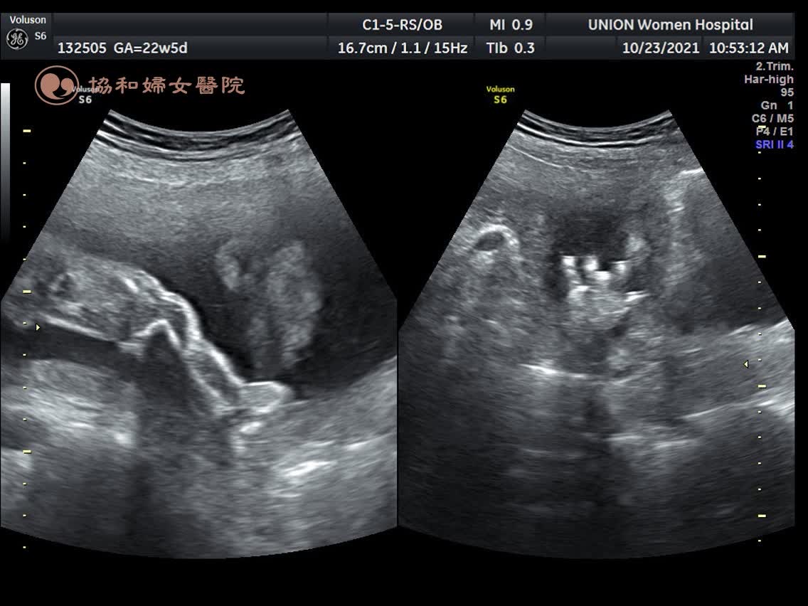 孕期22週，拍高層次超音波的心得！老三非常配合